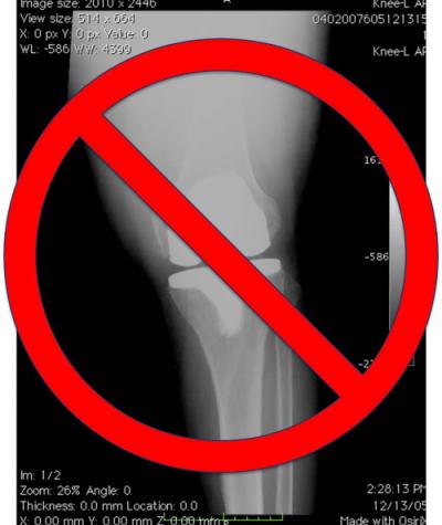 alternative to knee replacement surgery
